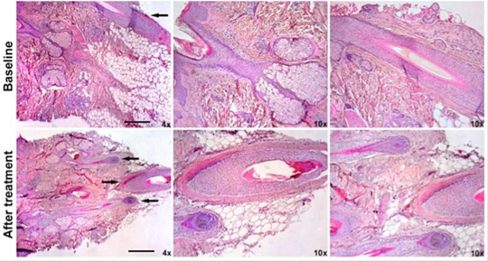 干细胞治疗脱发 干细胞存储治疗脱发