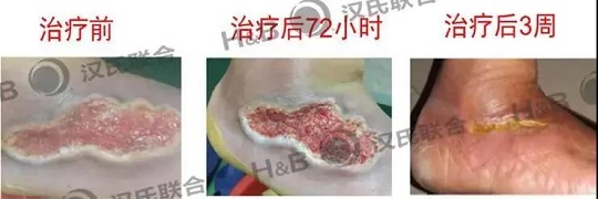 汉氏联合干细胞凝胶 糖尿病足治疗