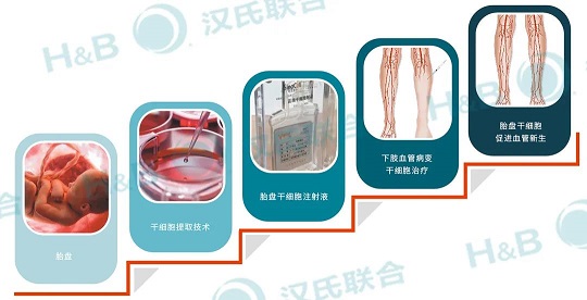干细胞疗法 重度下肢缺血治疗