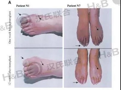 干细胞治疗糖尿病 汉氏联合