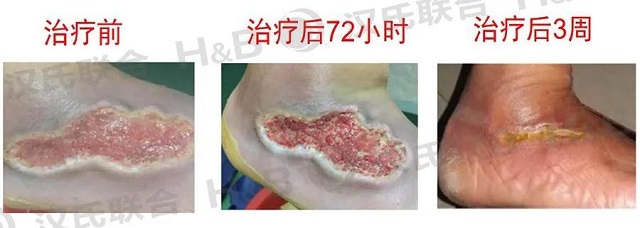 干细胞治疗糖尿病 汉氏联合