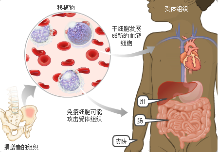 生物标记预测干细胞移植后免疫反应