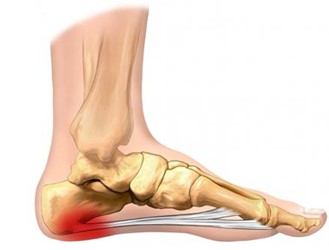 干细胞治疗足底筋膜炎