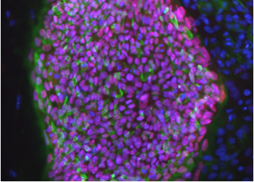 1型糖尿病人身上的细胞制备的干细胞集落