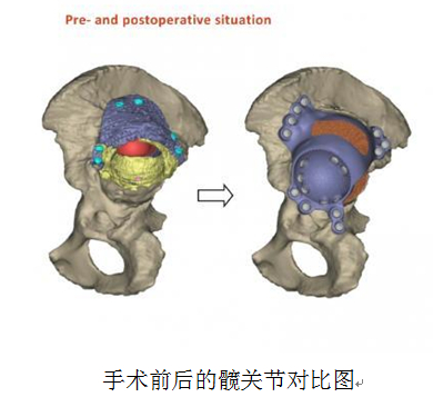 突破性的臀部干细胞手术改善患者生活质量