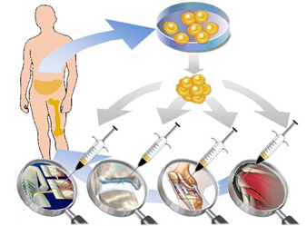 新设备采集干细胞可使移植零排斥