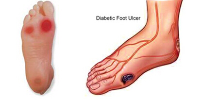 脐带间充质干细胞移植治疗糖尿病足的临床研究