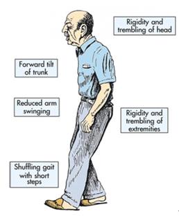 帕金森氏病干细胞疗法临床试验即将展开