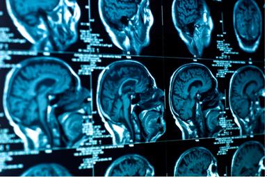 干细胞治疗帕金森氏症安全