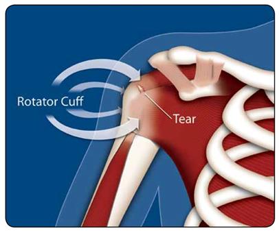 肩袖修复之干细胞疗法