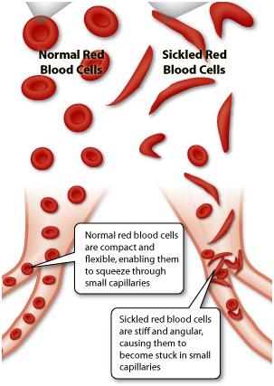 镰状细胞病人接受干细胞移植